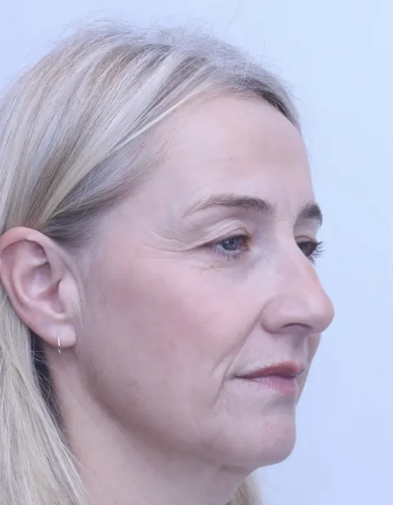 Upper blepharoplasty and brow lift, before, three-quarter view