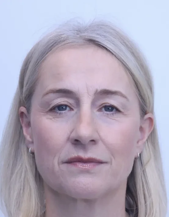 Upper blepharoplasty and brow lift, before, front view