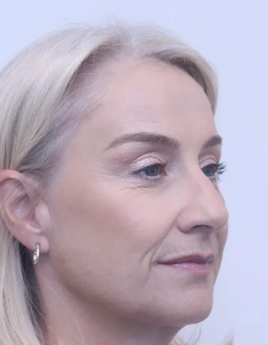 Upper blepharoplasty and brow lift, after, three-quarter view