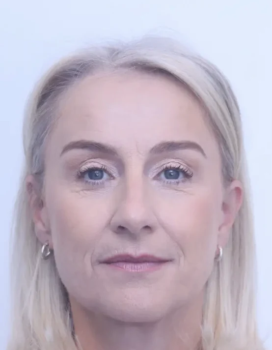 Upper blepharoplasty and brow lift, after, front view