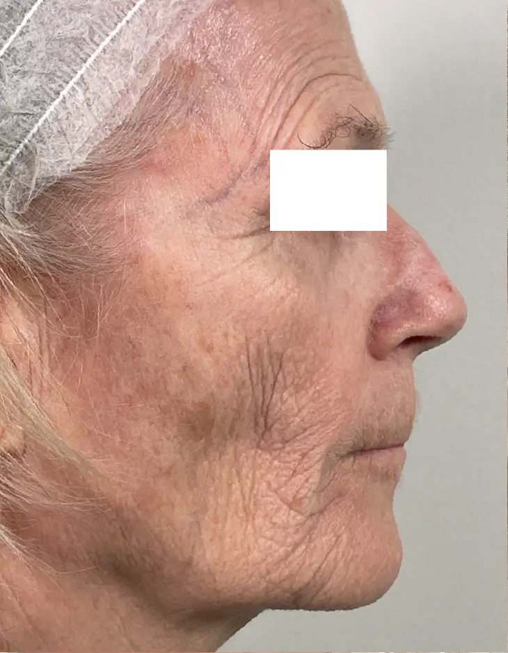 Contour TRL and Hybrid CO2 laser around the mouth, before, side view