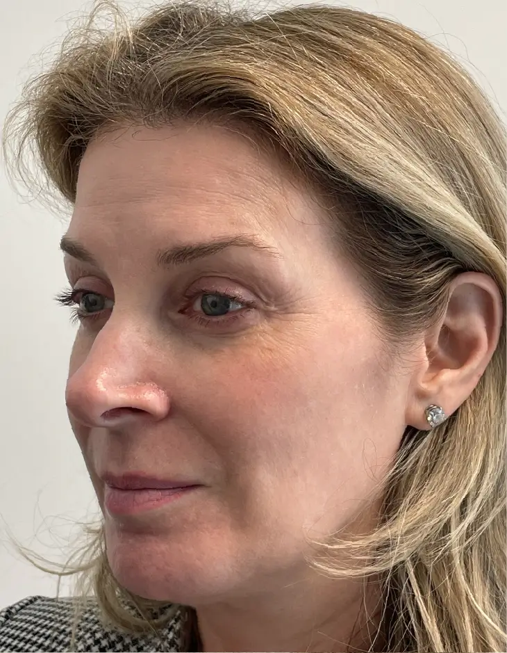 Sculptra and upper face neuromodulators, before, partial profile