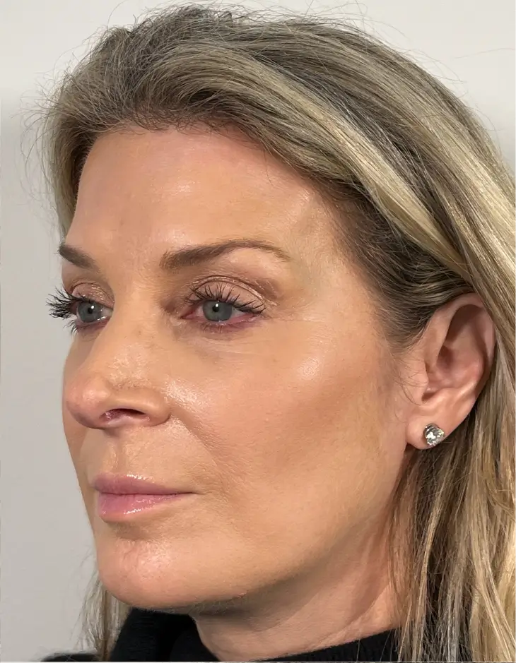 Sculptra and upper face neuromodulators, after, partial profile