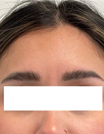 Front view of patient after Neuromodulator