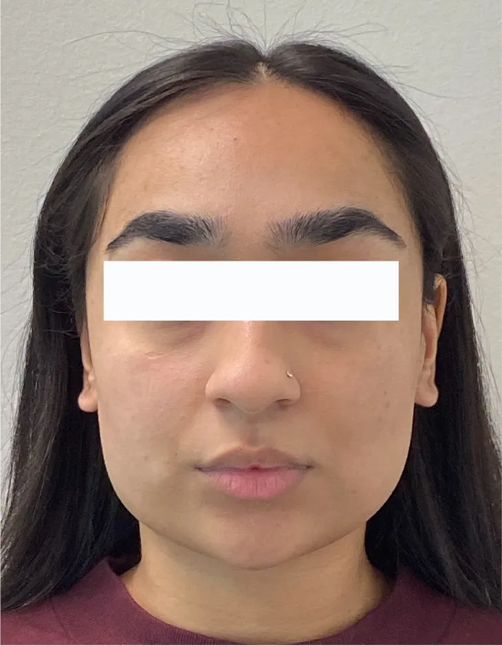 Front view of patient before Neuromodulator for Masseters
