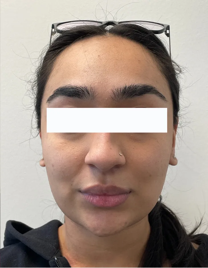 Front view of patient after Neuromodulator for Masseters