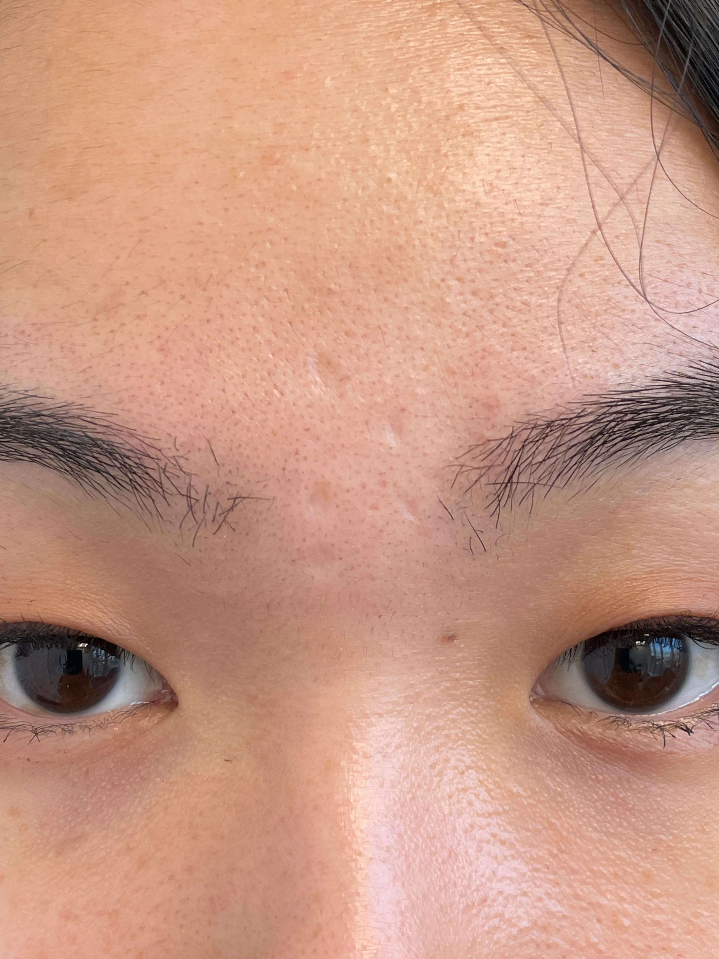 Front view of patient before ProFractional Laser
