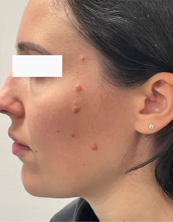 Side view of patient after Neuromodulator for Masseters