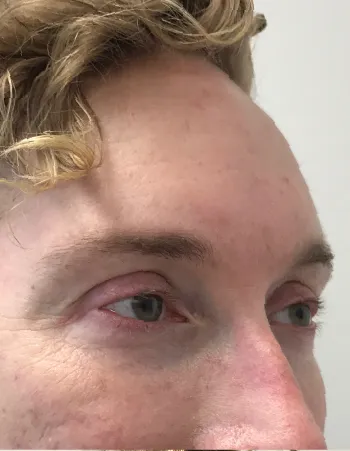 Partial side view of patient before Neuromodulator