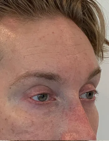 Partial side view of patient after Neuromodulator