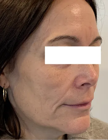 Partial side view of patient before Cheek Filler