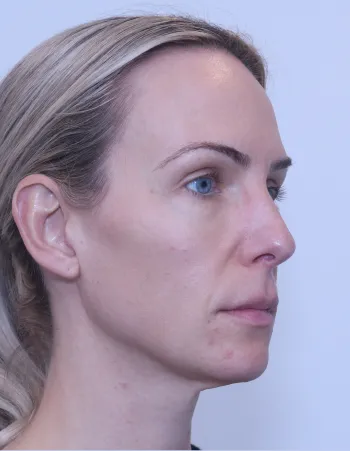 Partial Side view of patient before Mini Facelift
