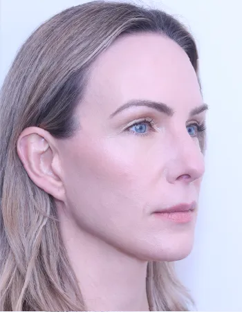 Partial side of patient 3 years after Mini Facelift