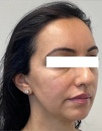 Partial side view of patient before Cheek Filler