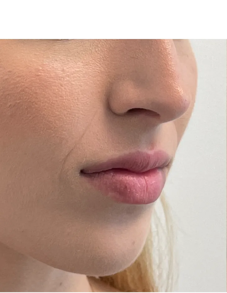 Partial profile view of patient before lip filler injection treatment