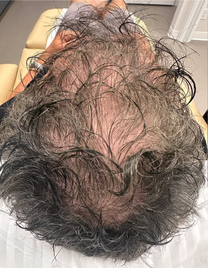 Top view of patient before advanced hair restoration