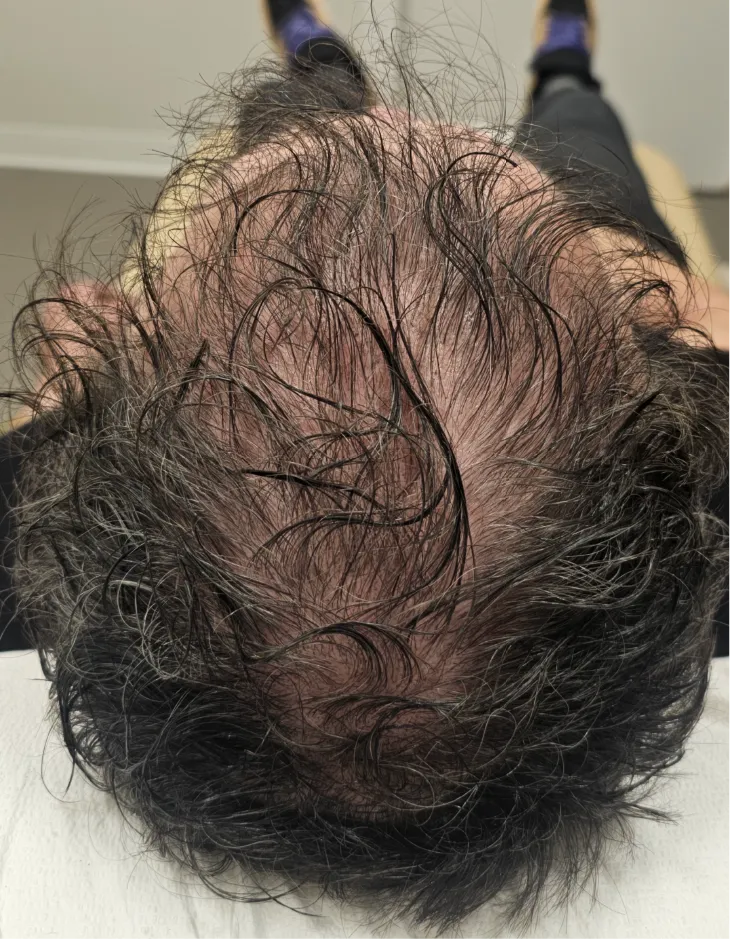 Top view of patient after advanced hair restoration
