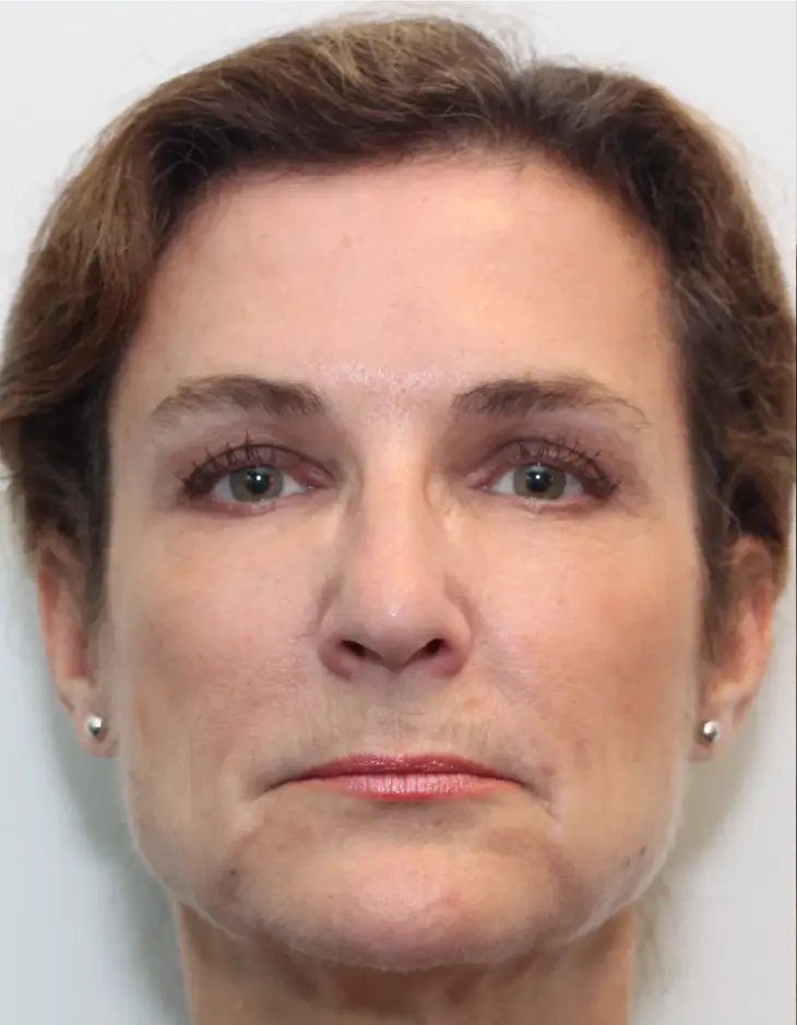 Front view of patient before Facelift