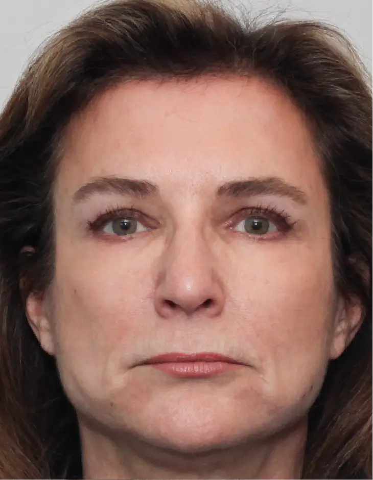 Front view of patient 10 months after Facelift