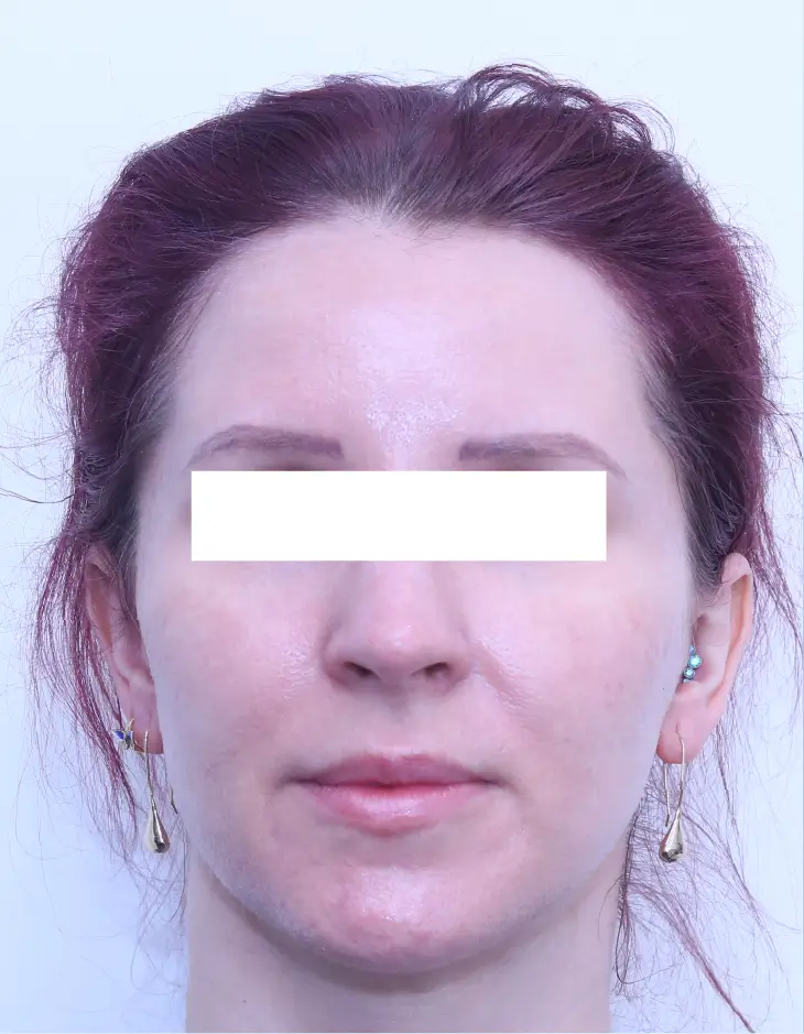 Front view of patient before Lip Lift Surgery