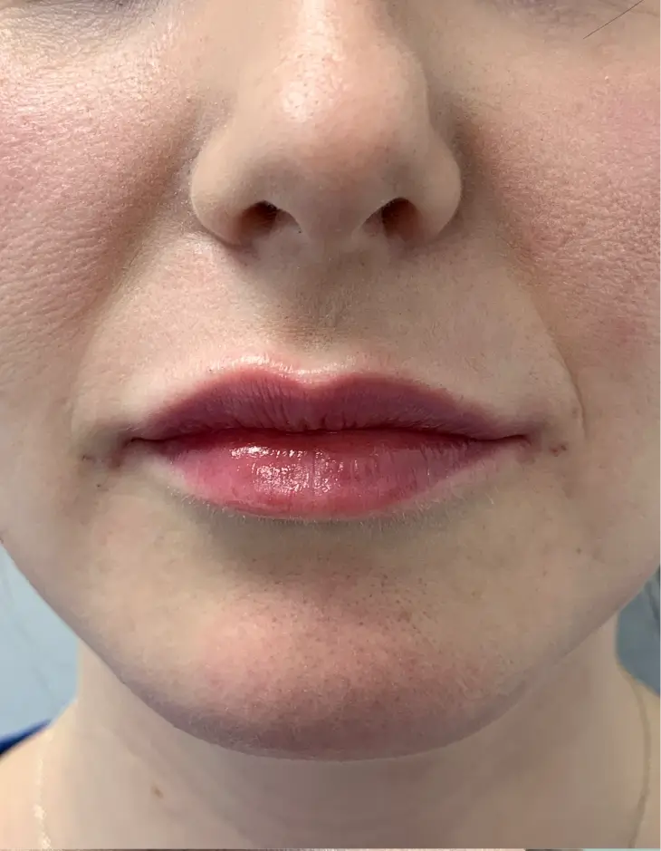 Front view of patient after Lip Filler