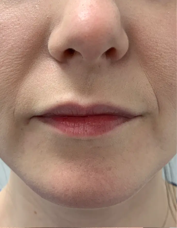 Front view of patient before Lip Filler