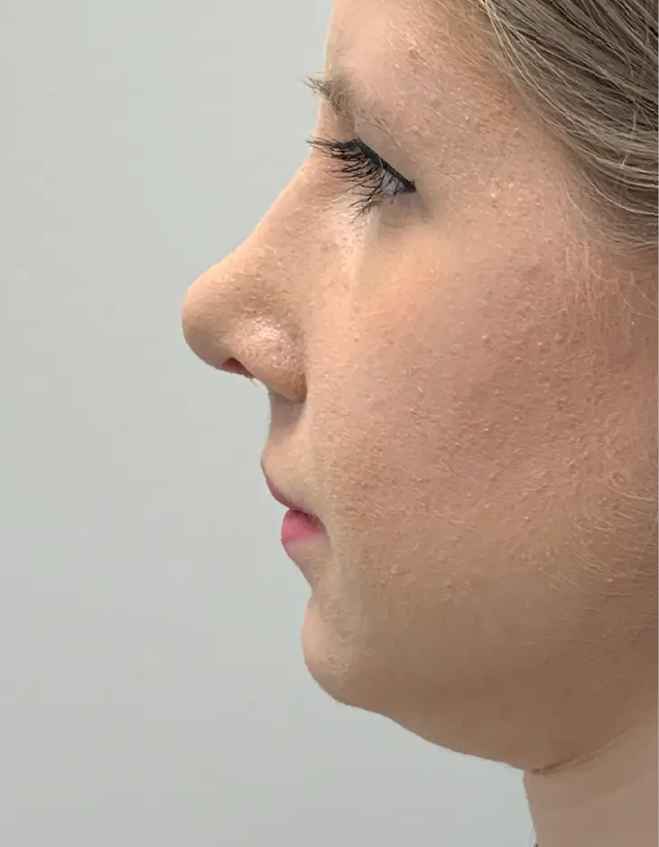 Side view of patient before Chin Filler
