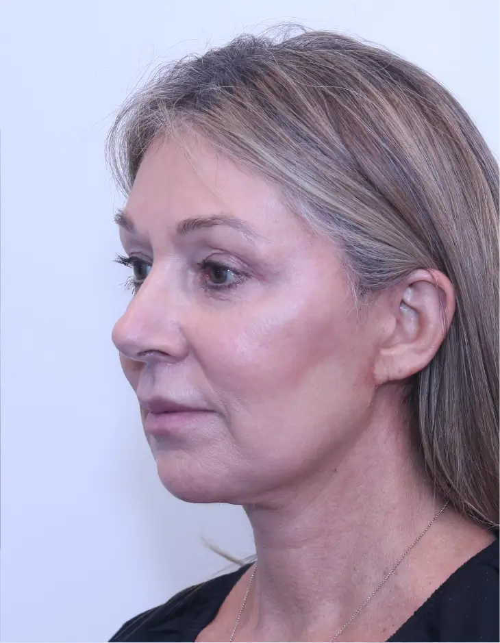 After Facelift + Neck Lift + Upper Blepharoplasty