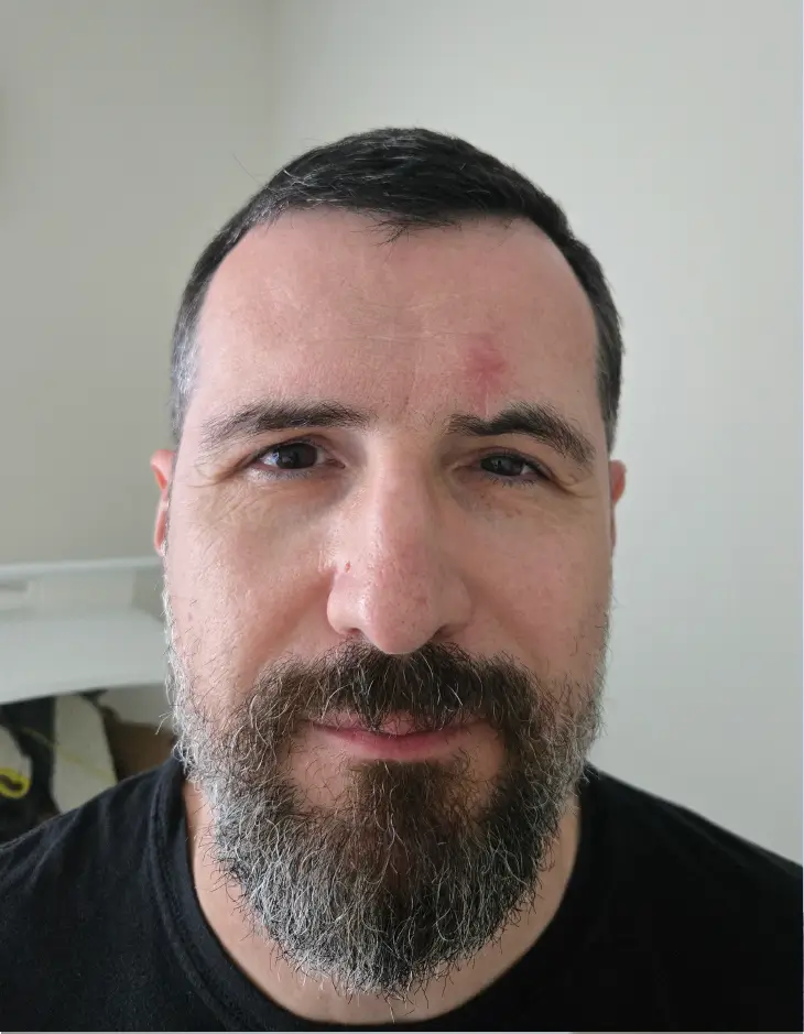 Front view of patient before Brow Lift surgery