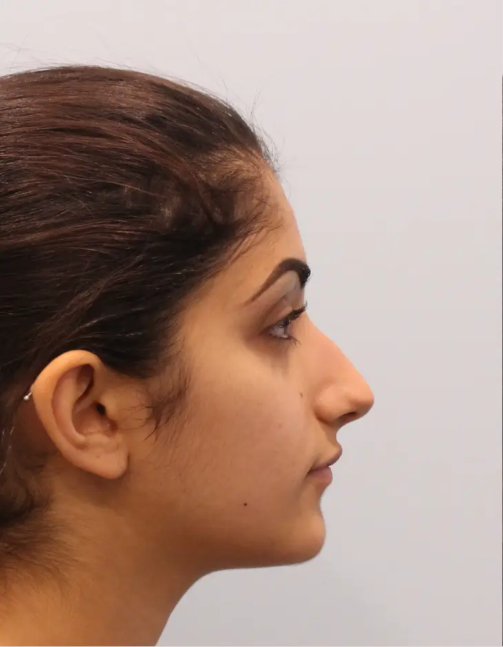 Side view of patient before Rhinoplasty