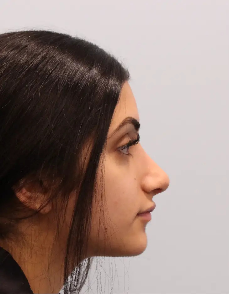 Side view of patient 2 months after Rhinoplasty