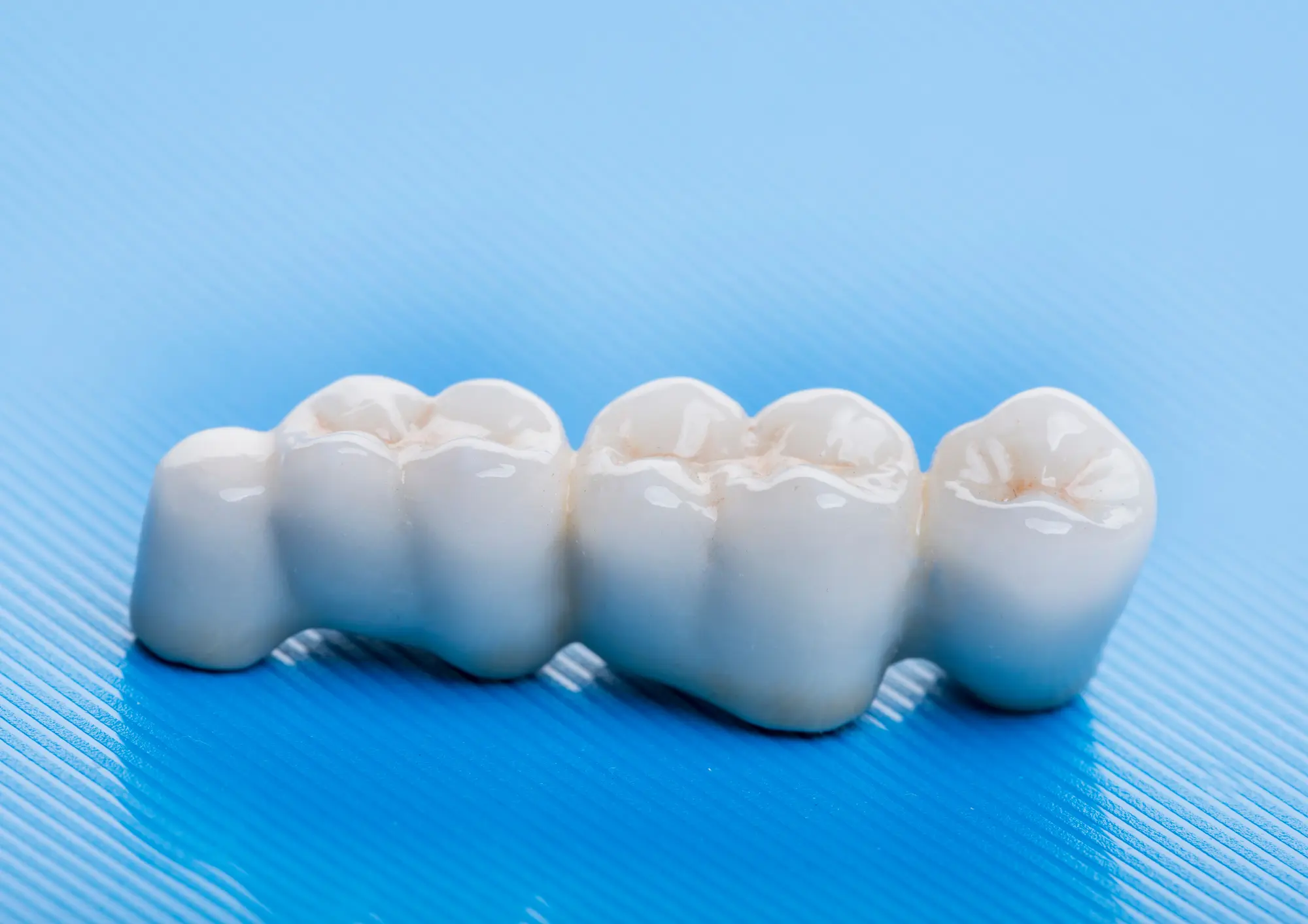 Dental Bridges vs. Implants: Which Is Better?