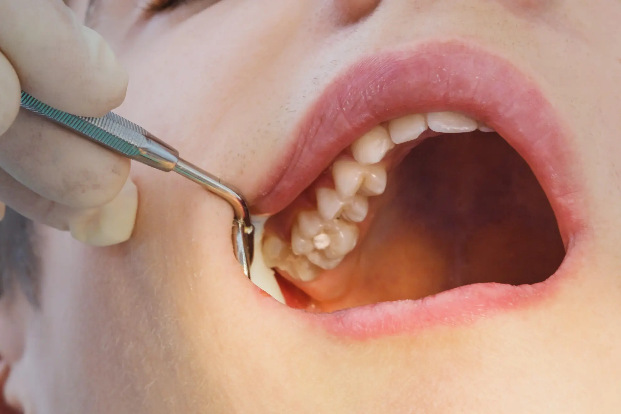 Is a Filling Falling Out a Dental Emergency?