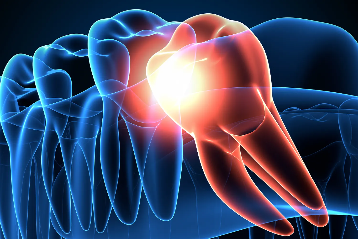 Wisdom Teeth Extractions in Lyons: What to Expect at Redstone Dental