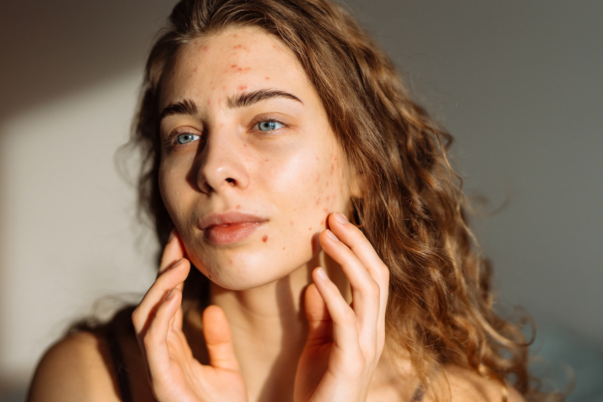 A adolescent girl with acne.