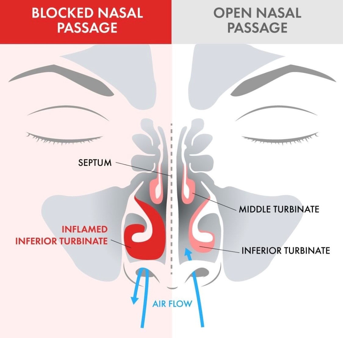 Blocked Sinus Compaerd to Open Sinus