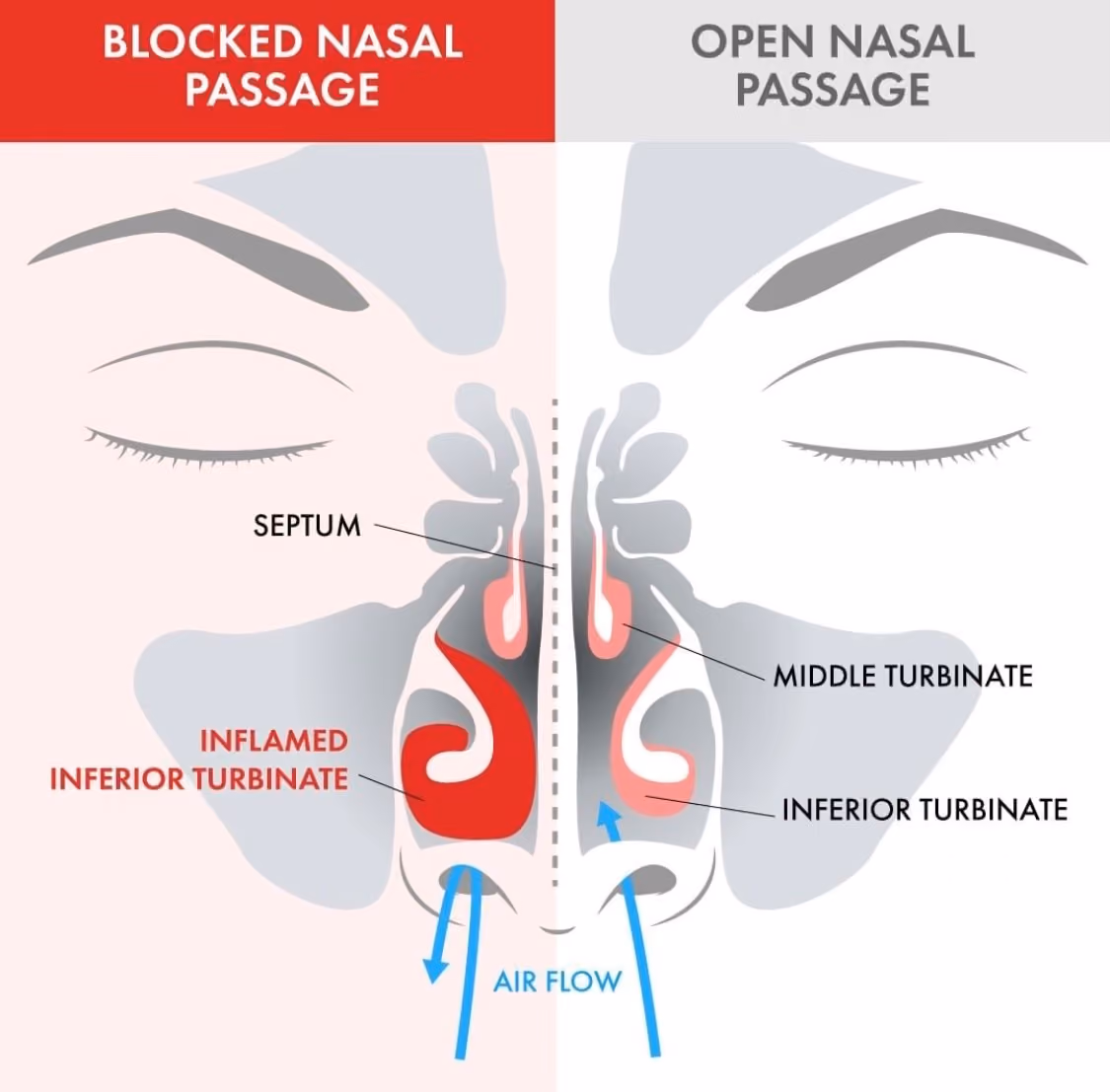 Blocked Sinus Compaerd to Open Sinus