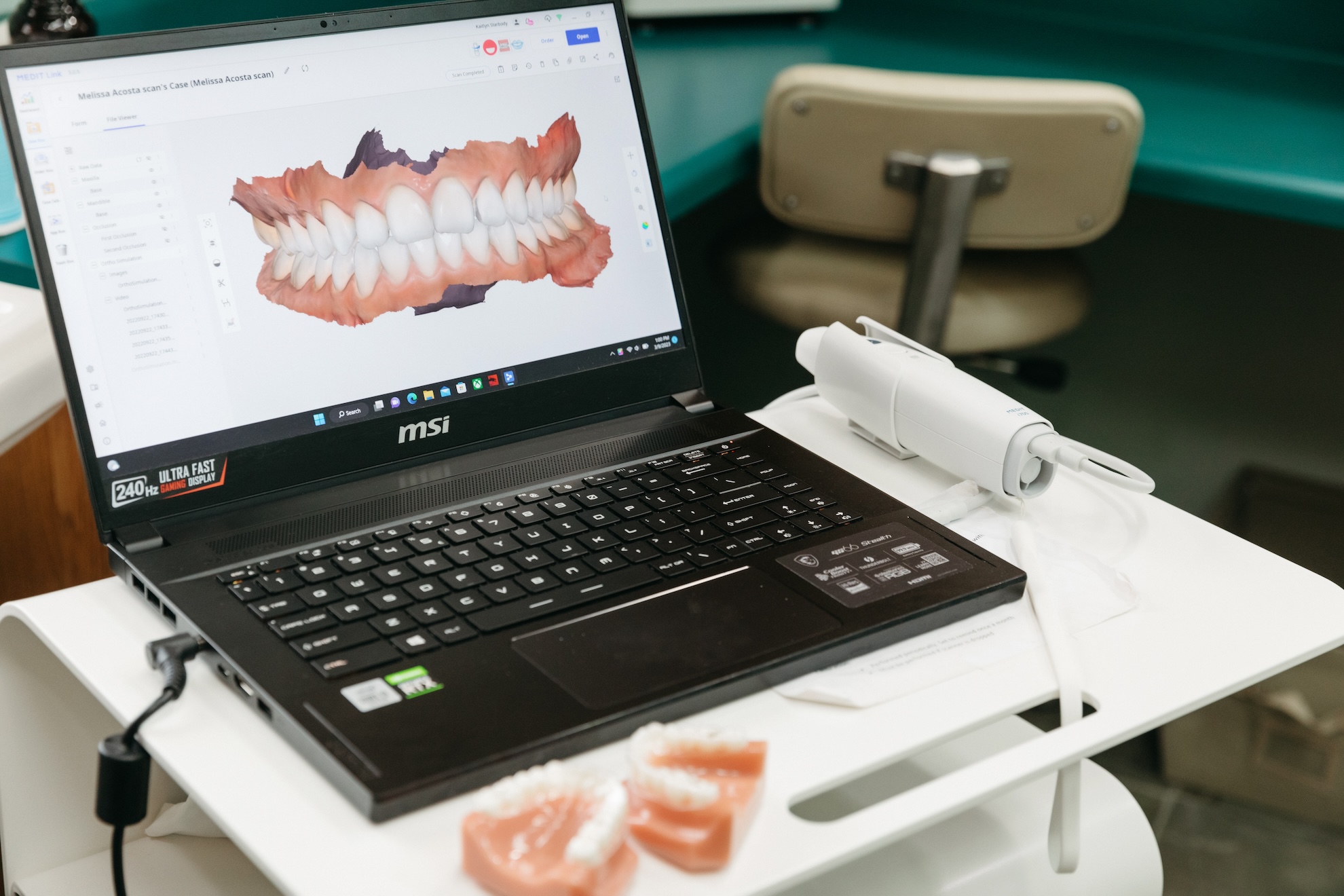 iTero scan of teeth for Invisalign.