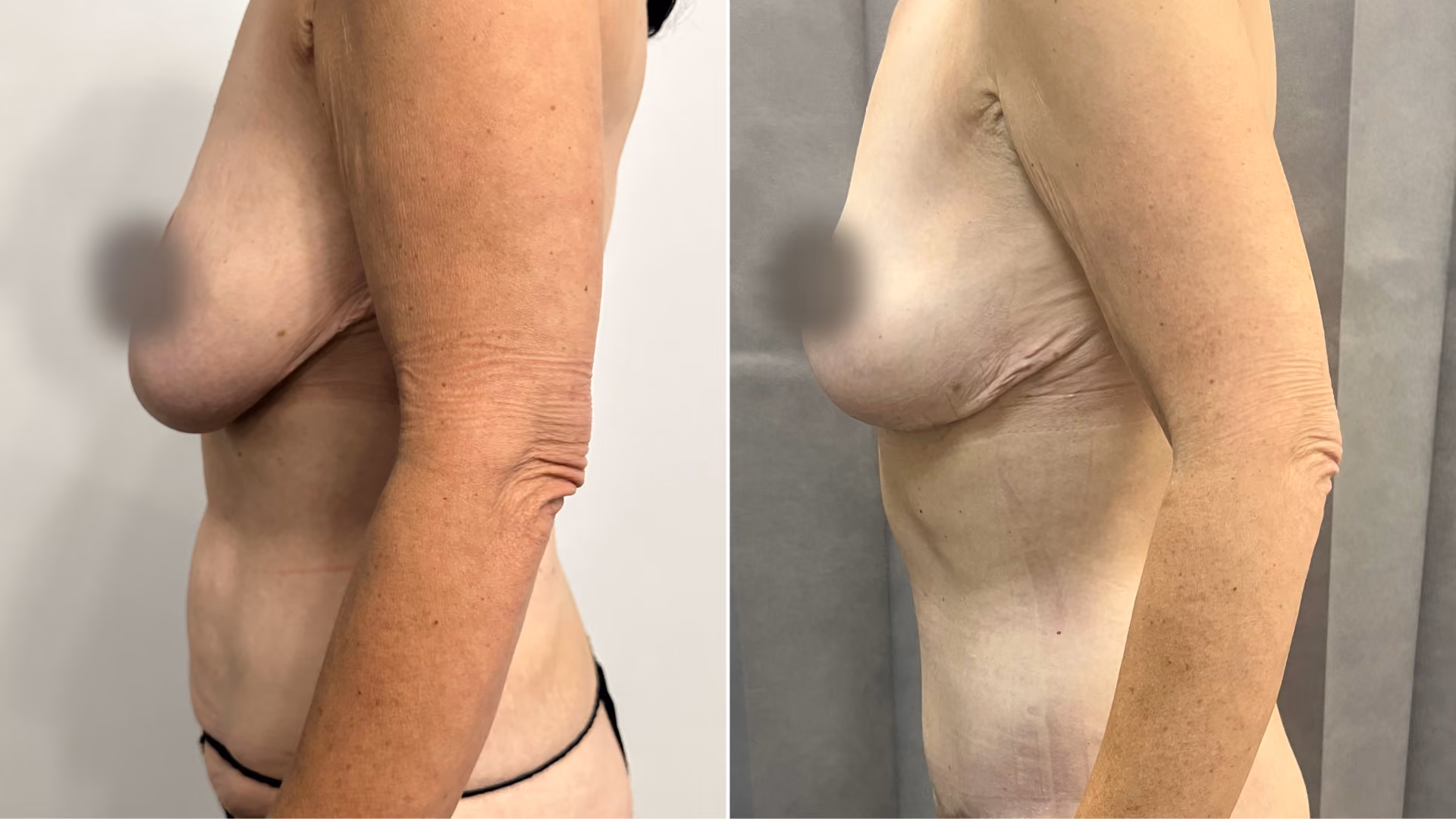 abdominoplasty and breast reduction