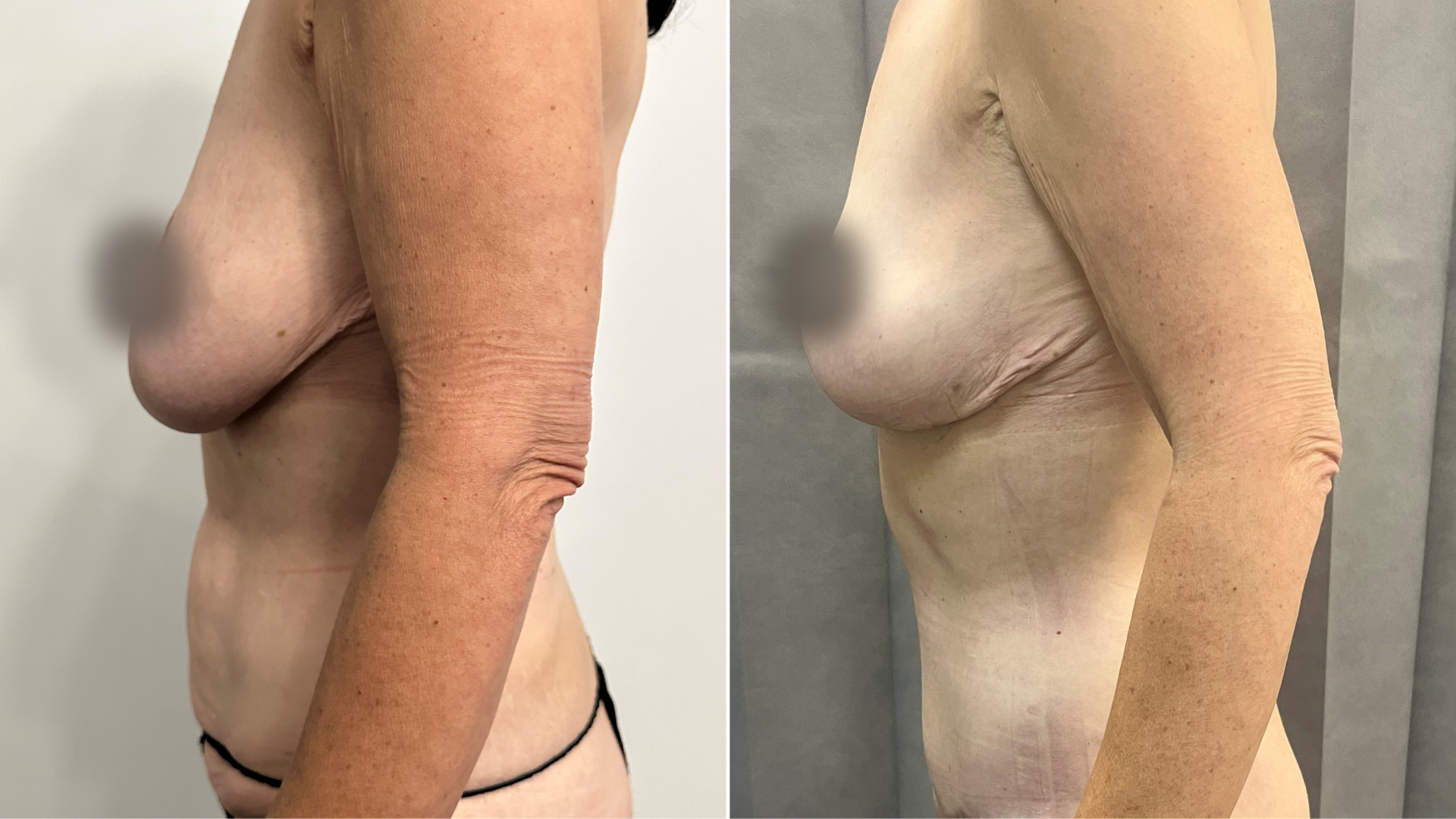 abdominoplasty and breast reduction