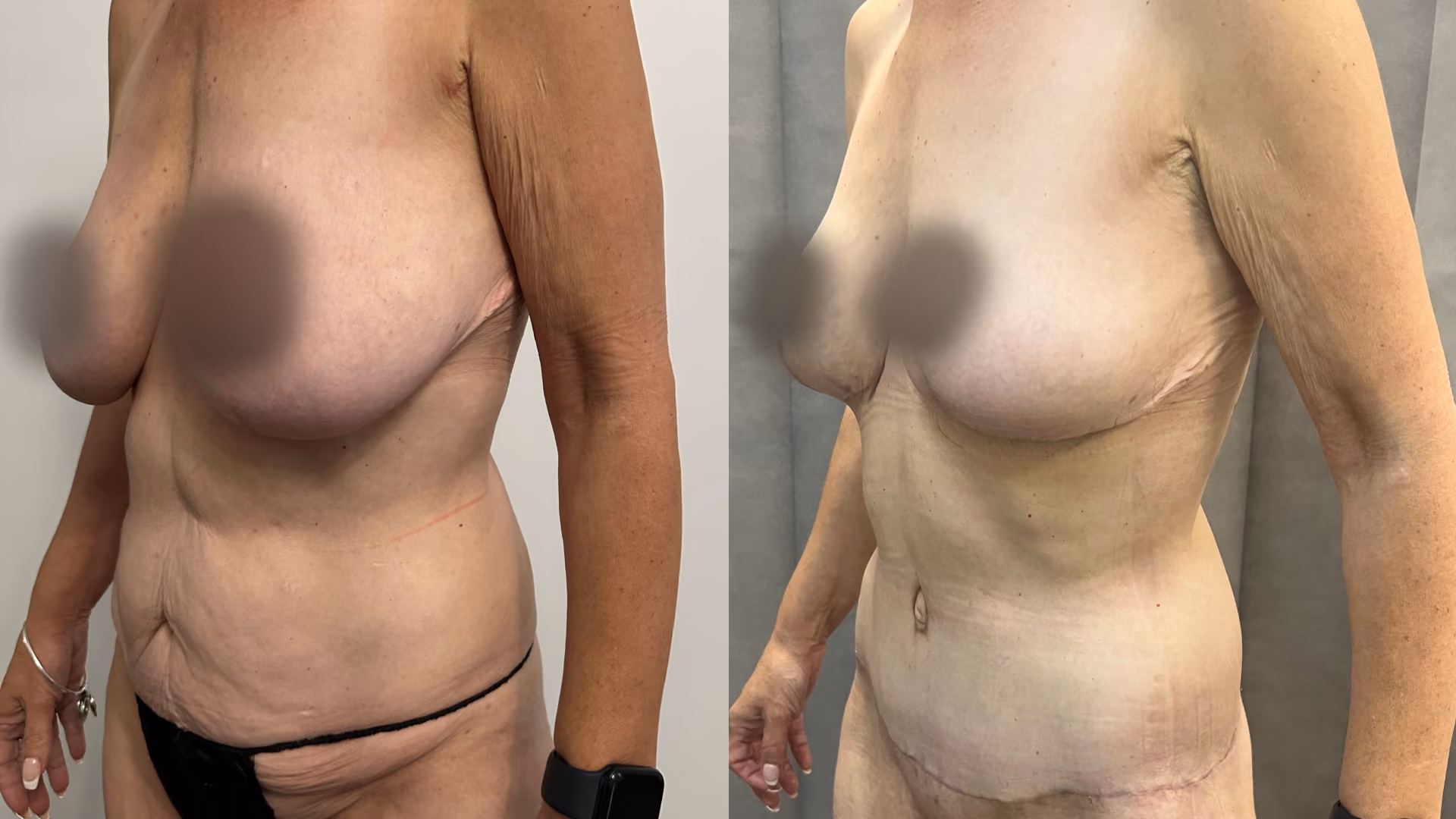abdominoplasty and breast reduction