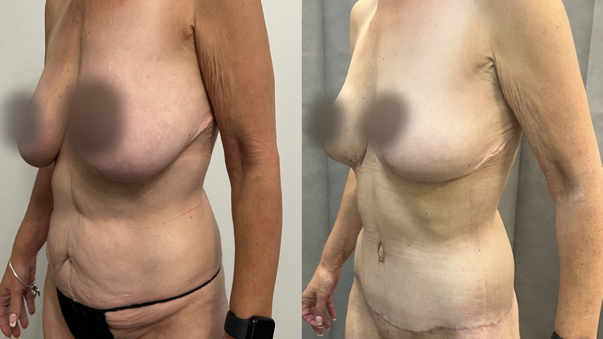abdominoplasty and breast reduction