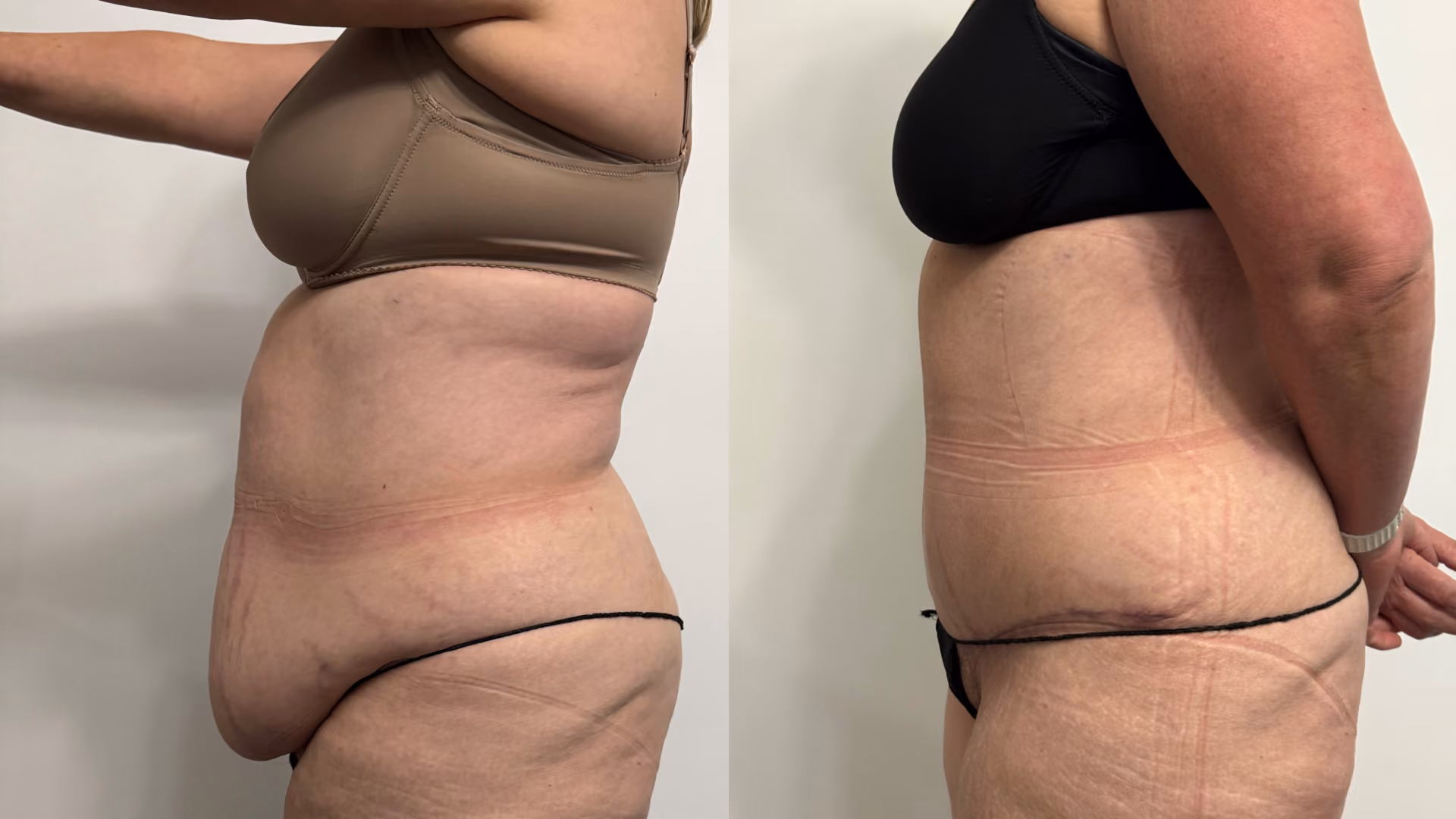 adominoplasty and liposuction