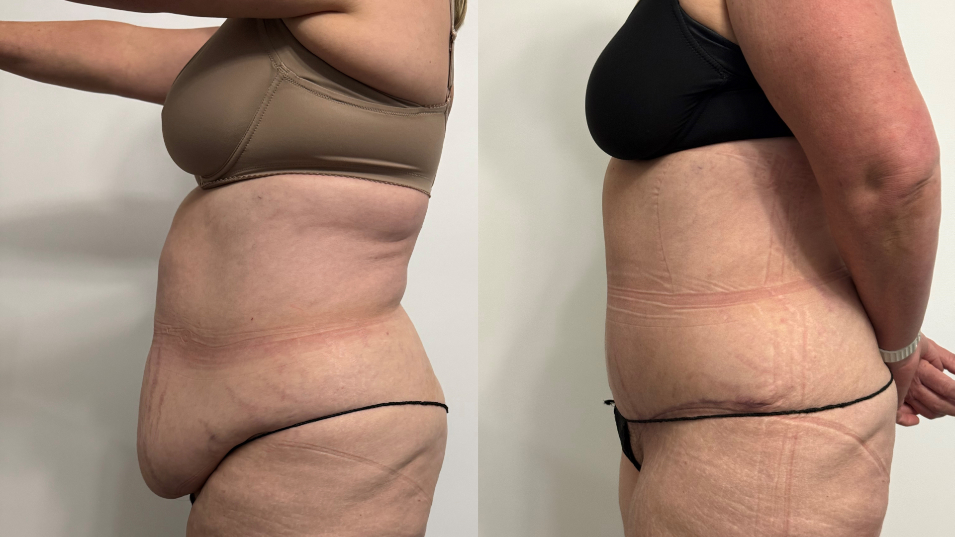 adominoplasty and liposuction