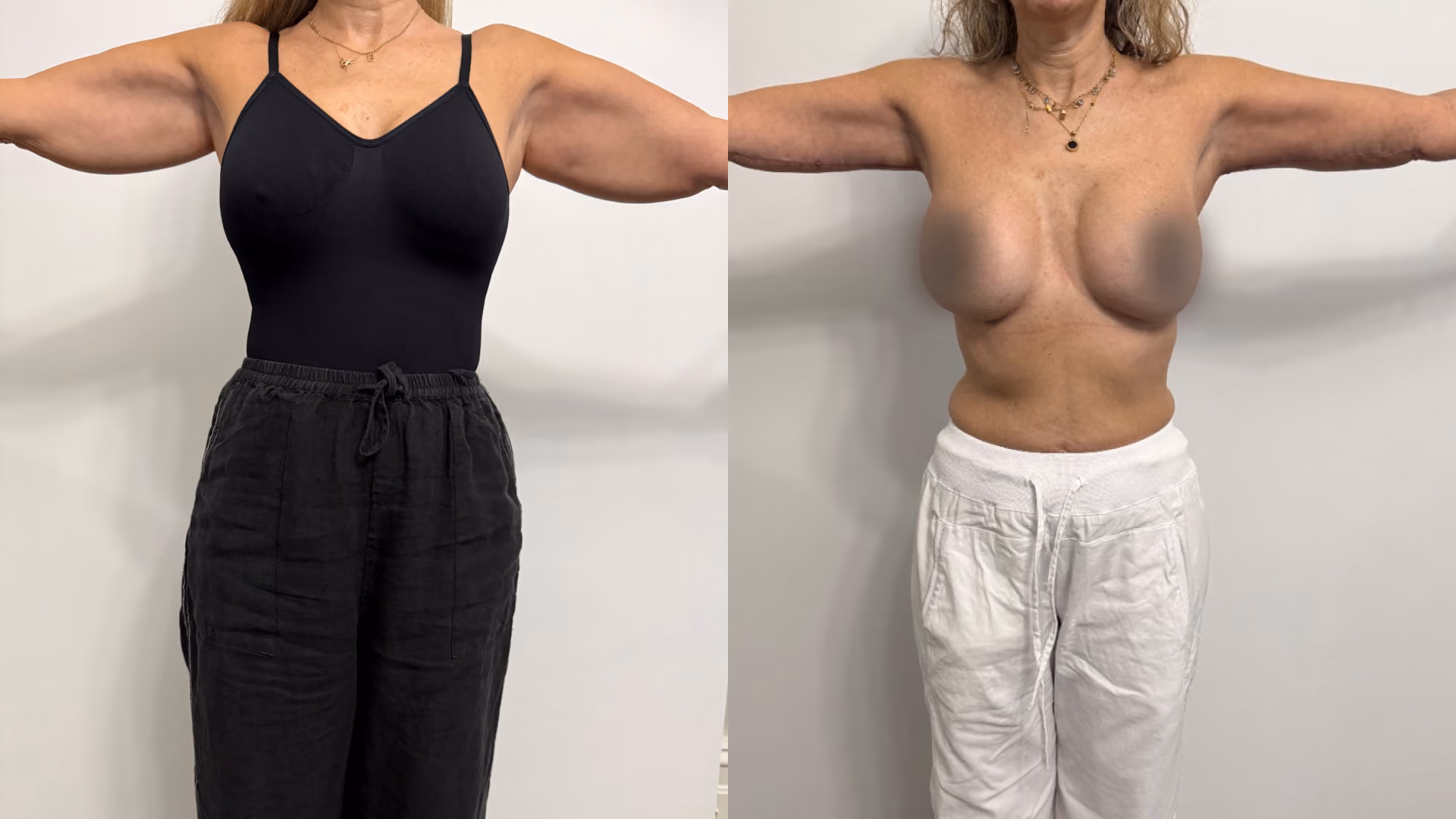 Bilateral brachioplasty and liposuction