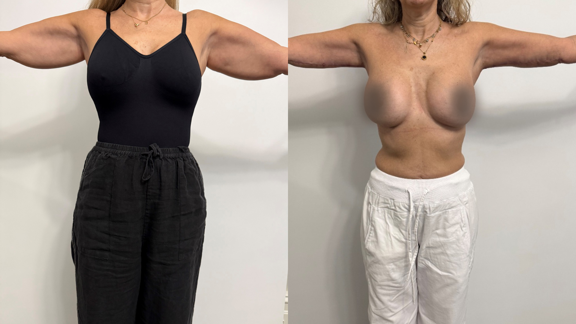 Bilateral brachioplasty and liposuction