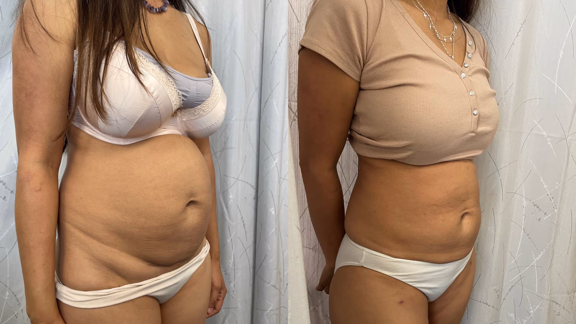 abdominoplasty