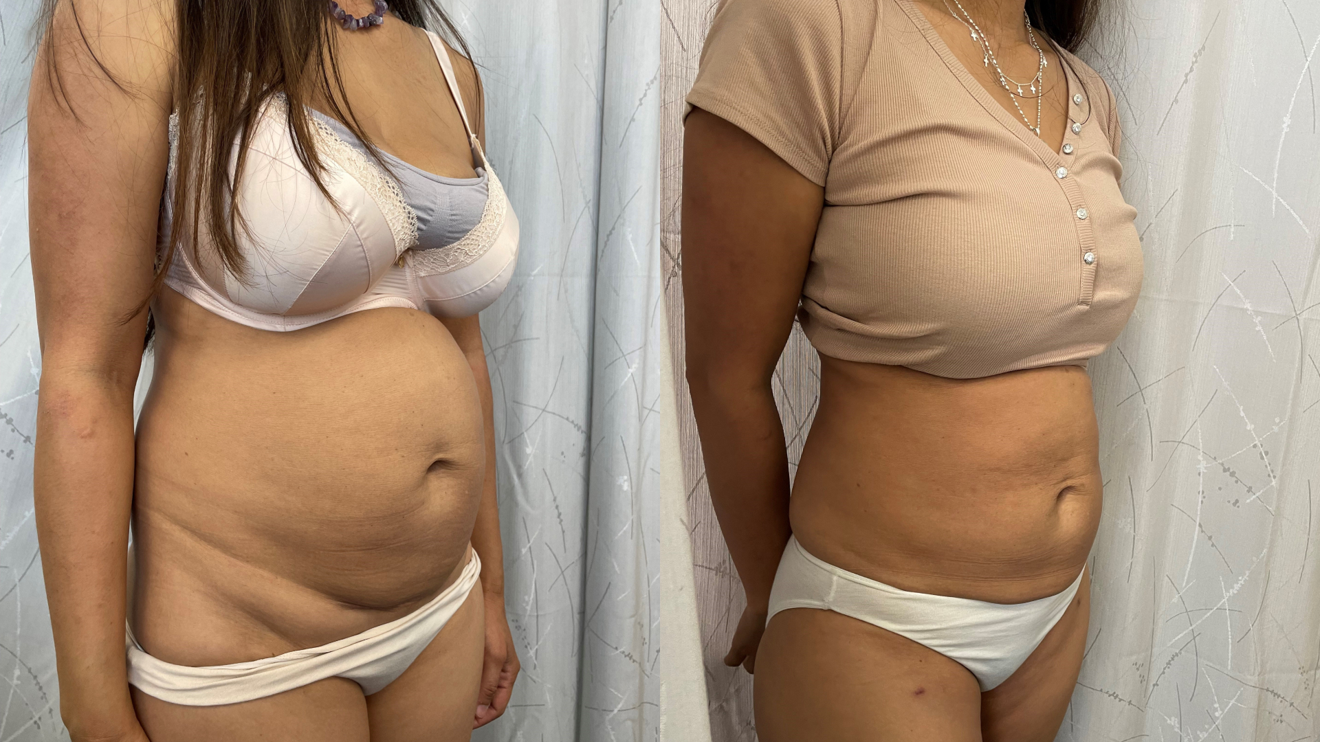 abdominoplasty