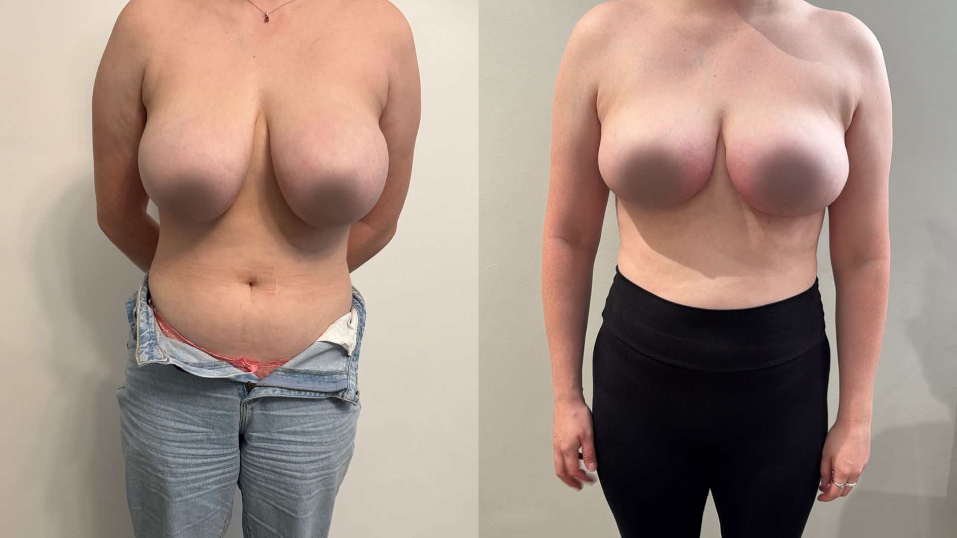 Bilateral breast reconstruction