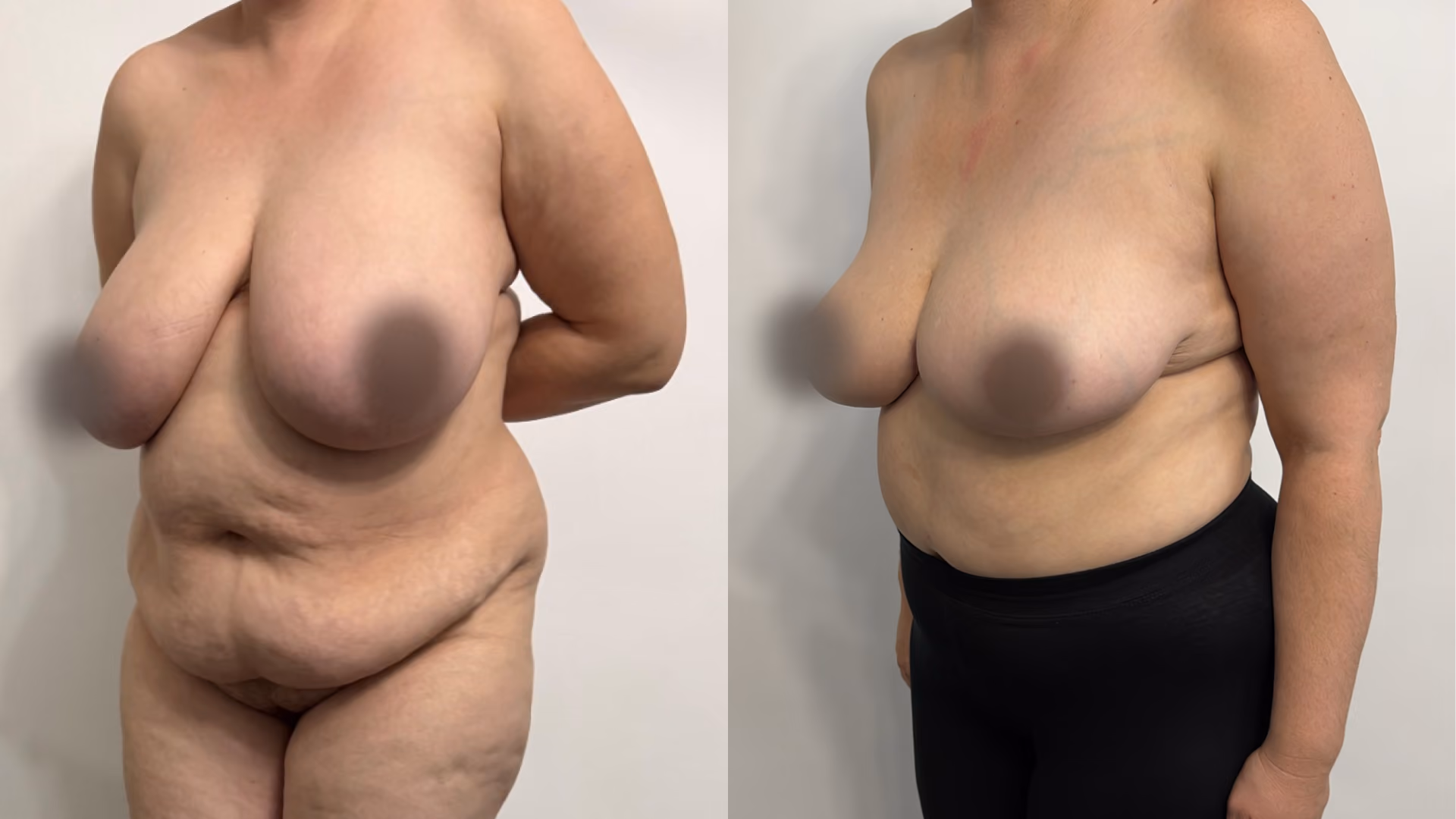 Bilat breast reduction. Cosm: abdominoplasty and Liposuction